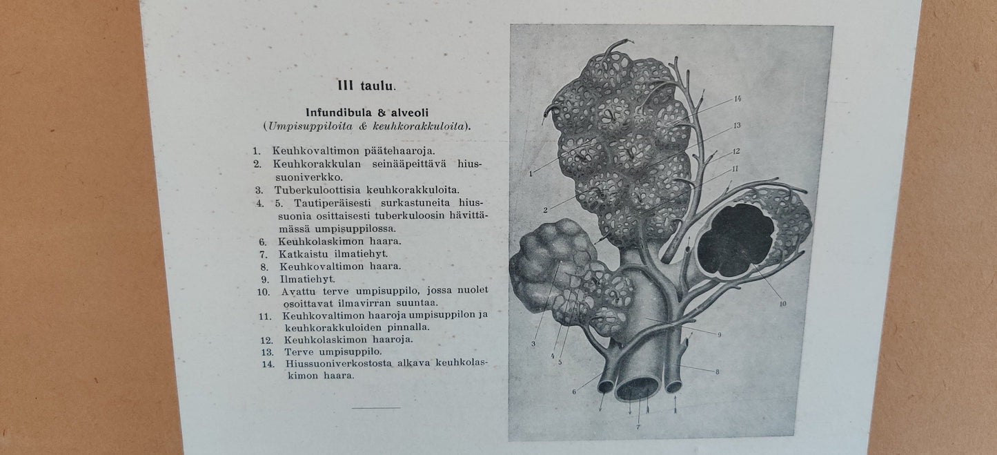 Opetustaulu - Infundibula ja Alveoli (Tuberkulositauluja III)