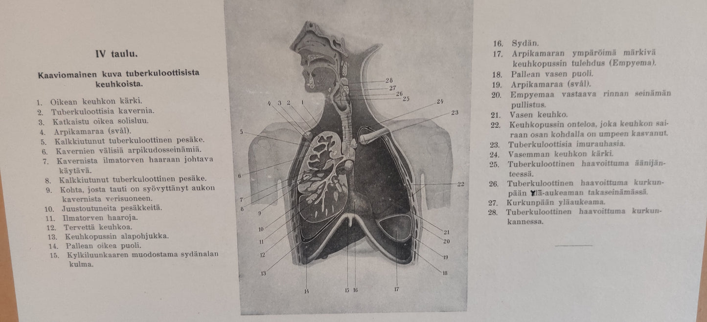Opetustaulu - Kaaviomainen Kuva Tuberkuloottiset Keuhkot (Tuberkulositauluja IV)